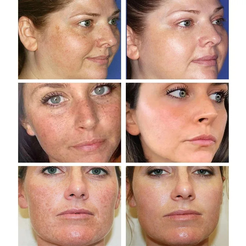 Clareamento creme de sardas re - Skincare Glowing avaliação e preço